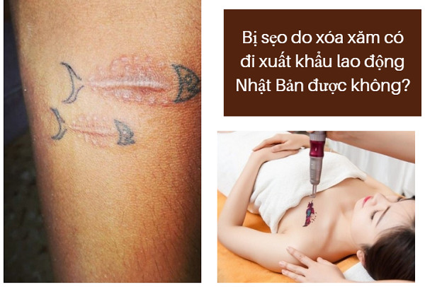 Xóa xăm không để lại sẹo là như thế nào Quy trình thực hiện  Phòng khám  Da liễu thẩm mỹ Bác sỹ Thái Hà